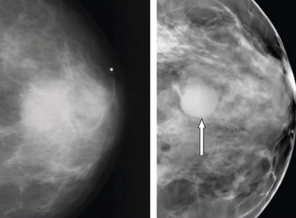 Tomosentez Mamografi